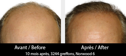 calvitie-resultats-robot-artas-photos-avant-apres